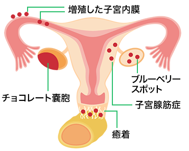 子宮内膜症の発生部位