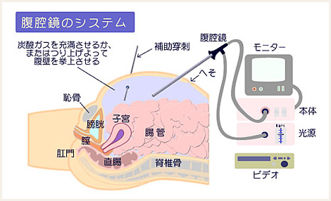 腹腔鏡手術IMAGE