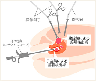 子宮鏡手術IMAGE